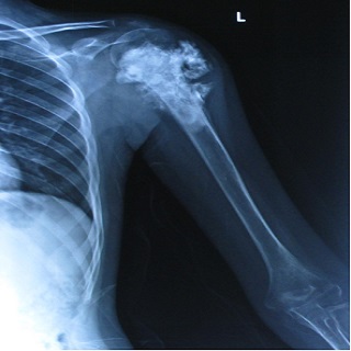 Osteosarcoma