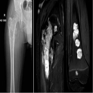 Ewing Sarcoma