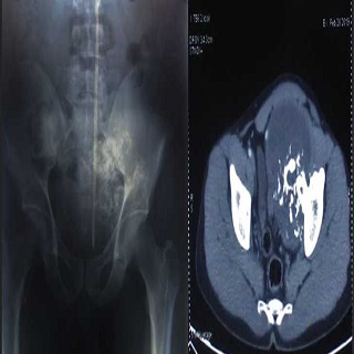 Chondrosarcoma