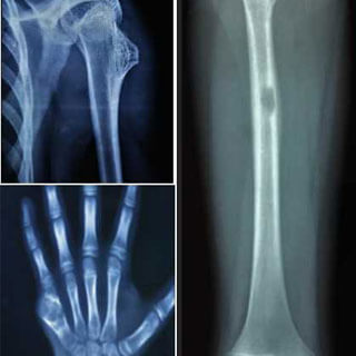 Other Benign Bone Tumors