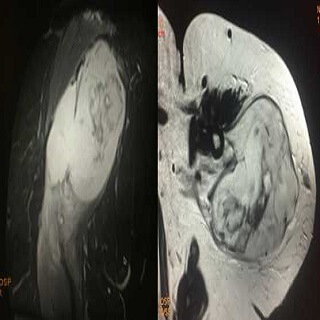 Soft Tissue Sarcoma