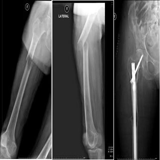 Metastatic Bone Cancer