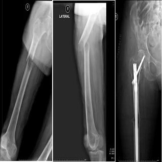 Metastatic Bone Cancer